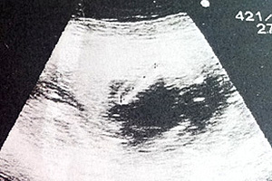 妊娠20週エコー写真